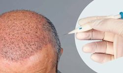 Antalya Saç Ekimi – Haarex Clinic