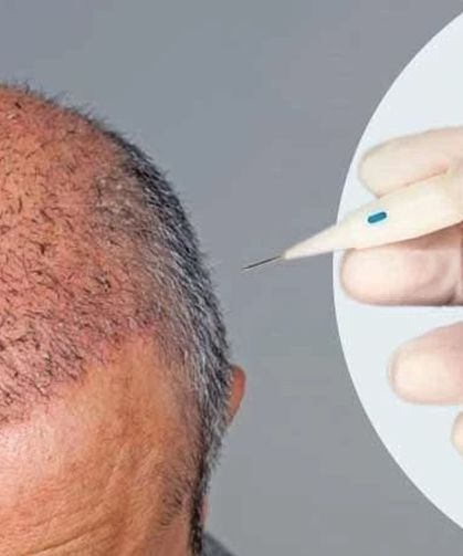 Antalya Saç Ekimi – Haarex Clinic